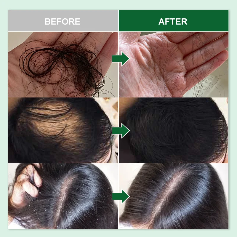 PURC Масло от Розмарин за Растежа на косата за Мъже И Жени Серум за Коса Против Косопад Грижа За Кожата на главата Отглеждане на Етерични Масла, Продукти за Красота, Здраве 2023