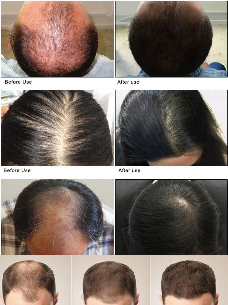 Бърз Растеж на косата Масло За Растеж на Косата е по-Ефективно Средство От Наследствено Оплешивяване, косопад Послеродовое Косопад Себорейное Средство Срещу Косопад